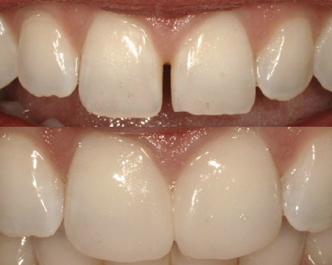 diastema closure