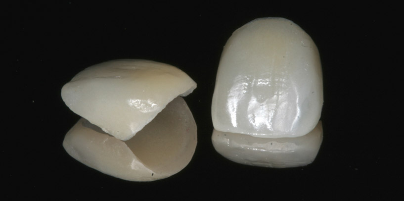 Porcelain-Veneers-Preston-Lancashire