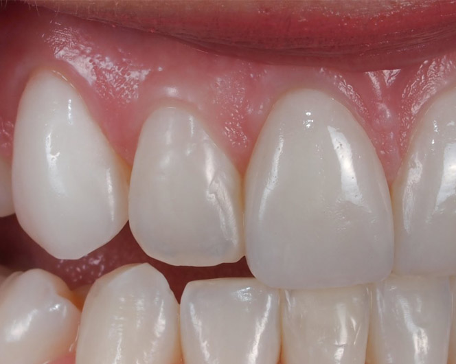 dental-lab-emax-veneers