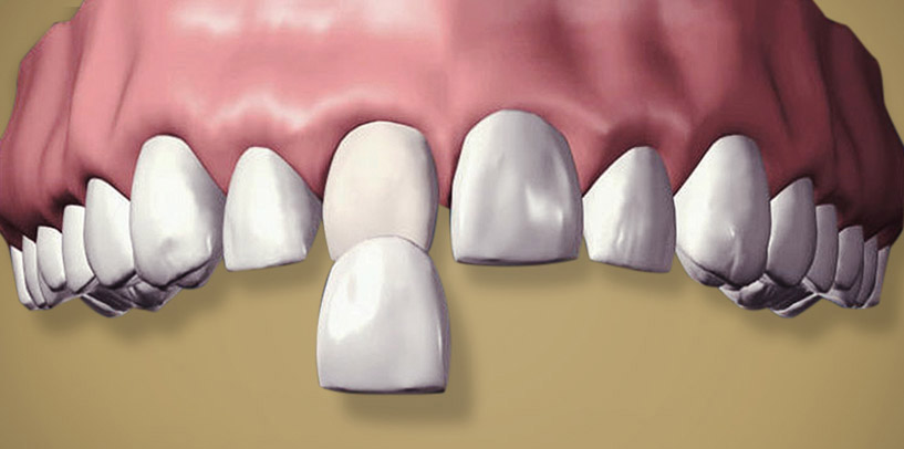 porcelain-veneers-2