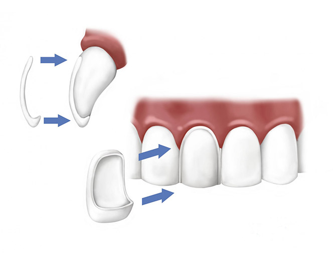 porcelain-veneers-beverly-hills