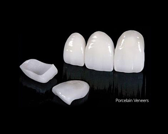 what-is-porcelain-veneers