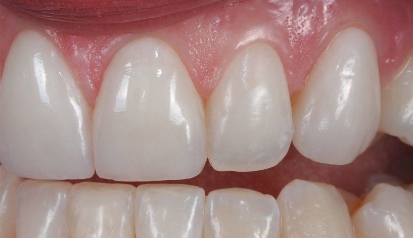 dental-lab-pressed-feldspathic-layered-veneer