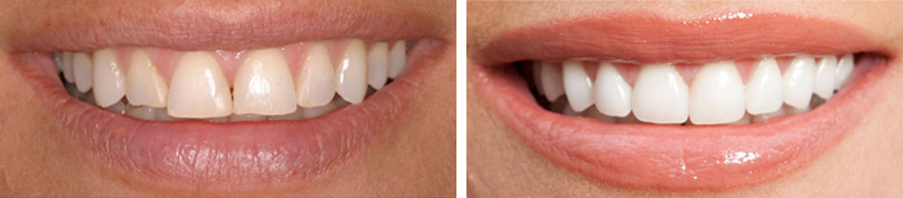 pic-composite-veneers