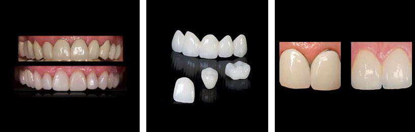 all_zirconia_restorations