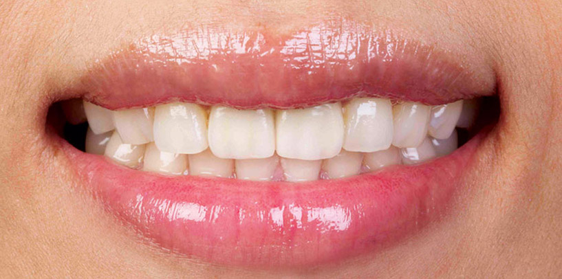 services-cs-original-bruxzir-solid-zirconia-02